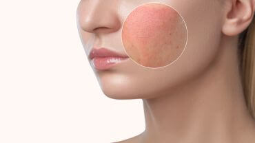 Rode Vlekken op de Huid: Oorzaken en Camouflagetechnieken