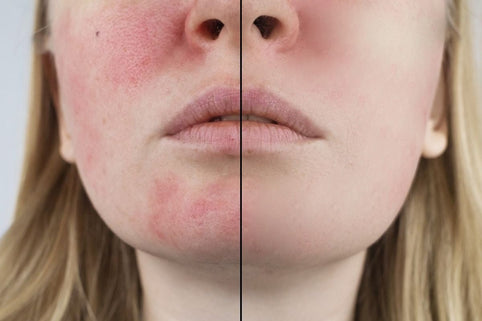 Make-up bei Rosazea: Foundation und Concealer für sichtbare Rötungen